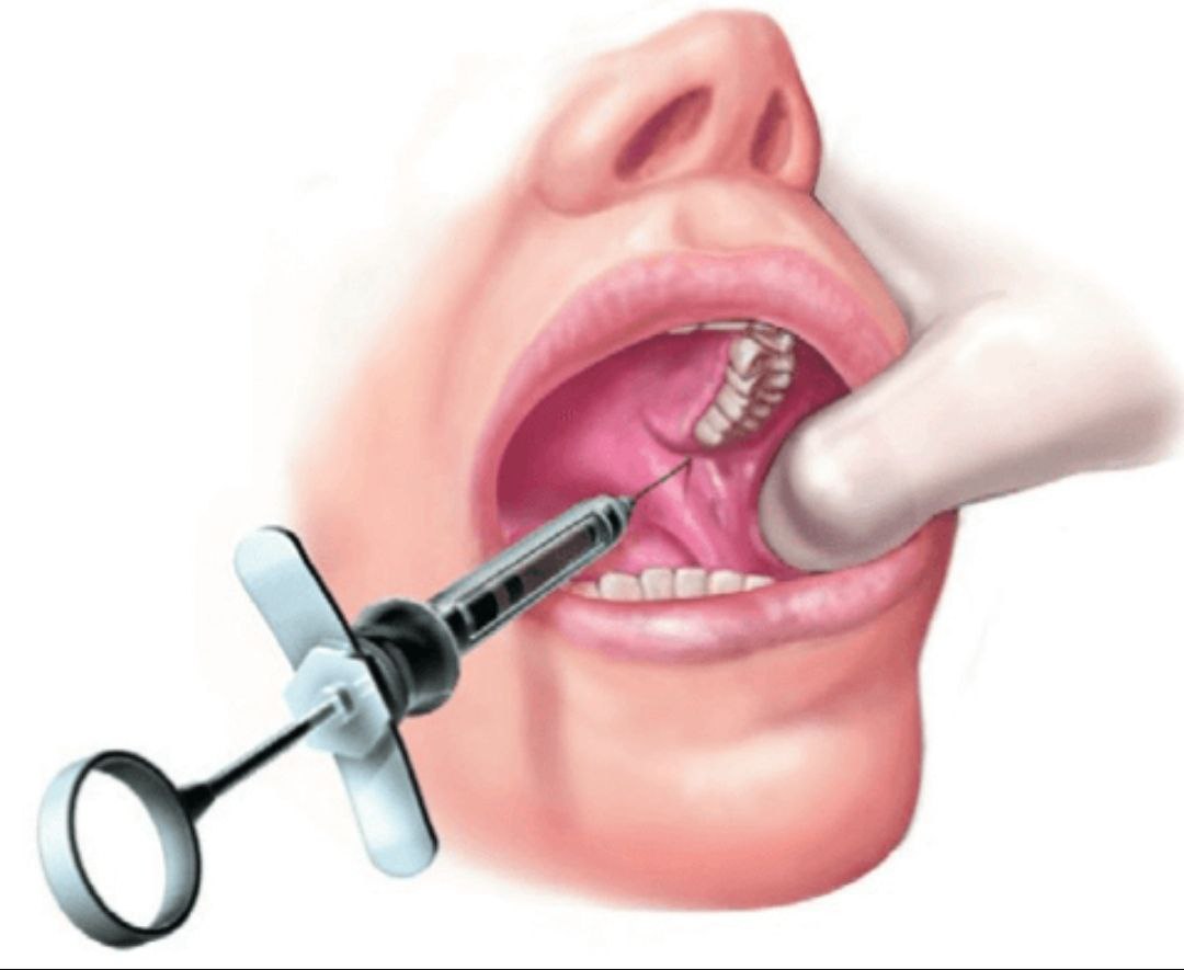 Укол для удаления зуба. Проводниковая анестезия в стоматологии торусальная. Торусальная анестезия техника. Торусальная анестезия нижней челюсти. Проводниковая анестезия мандибулярная.